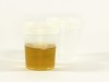 Heat and Acetic Acid Test for Proteinuria: Principle, Procedure and Interpretation