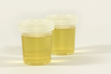 Urine Specimen for Rothera’s Test