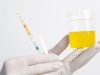 Lang’s Test for Ketone Bodies: Principle, Procedure, and Interpretation
