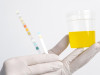 Lang’s Test for Ketone Bodies: Principle, Procedure, and Interpretation