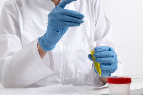 Urine Specimen for Sulphosalicylic Acid Test