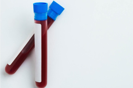Blood Sample for Glucose Estimation by Folin-Wu Method