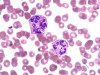 Arneth Count for Neutrophils: Principle, Procedure, and Clinical Significance