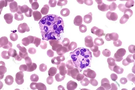 Hypersegmented Neutrophils
