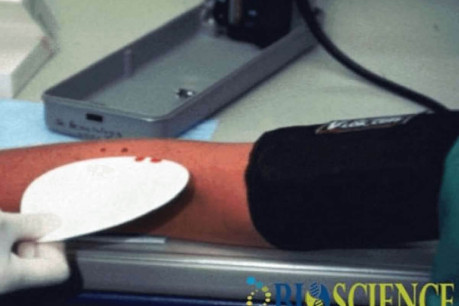 Bleeding Time (BT) and Clotting Time (CT)