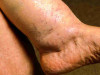 Hyponatraemia: Causes, Symptoms, Diagnosis, and Treatment