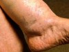 Hyponatraemia: Causes, Symptoms, Diagnosis, and Treatment