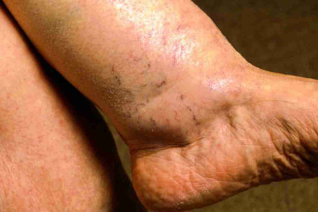 Hyponatraemia