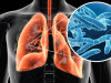 Legionnaires’ Disease: Causes, Symptoms, Diagnosis, and Treatment