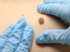 Basal Cell Carcinoma: Causes, Symptoms, and Treatment