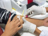 Young Strokes Linked to Blood-Type Genes: Large Study Finds ABO Variants and Clotting Risk Drive Early-Onset Ischemic Stroke