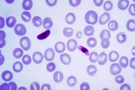 Blood smear of Plasmodium falciparum (gametocytes - sexual forms).