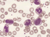 Neutrophil disorders and their management
