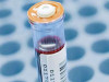 Blood Test for Colorectal Cancer - Epigenomics AG