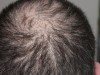 Lab-Grown Hair Follicles That Cycle Naturally Mark a Turning Point for Regenerative Medicine