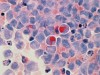 Scientists Identify a Molecular Switch That Helps Cancer Cells Rewire Their Energy Use