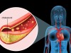 New Cholesterol Guidelines Say Start Earlier to Prevent Heart Disease