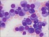 How do you die from multiple myeloma?