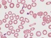 Iron-Deficiency Anemia in Ulcerative Colitis