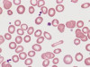 Iron-Deficiency Anemia in Ulcerative Colitis