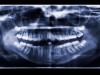 Japan Completes First Human Trial of Tooth-Regrowth Drug Blocking USAG-1 Protein